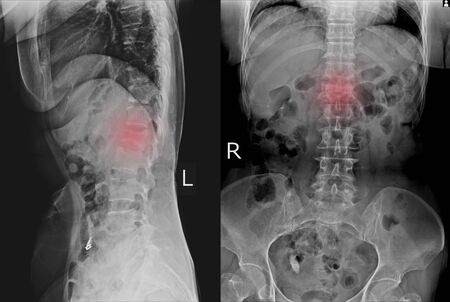 X-ray L-S Spine  AP,LATERAL: Finding Moderate compression fracture of L1 vertebra and Lumbar spondylosis.の写真素材