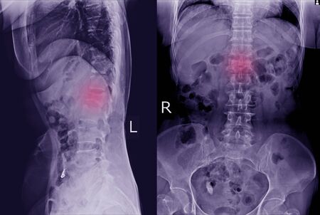 X-ray L-S Spine  AP,LATERAL: Finding Moderate compression fracture of L1 vertebra and Lumbar spondylosis.の写真素材
