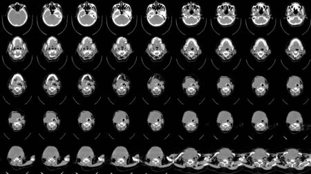 CT SCAN OF THE NECK HISTORY: A69-year-old female presented with neck mass and right TVC paralysis.The mass pressures effect to adjacent structures as describe above. Probably malignancy, tissue diagnosis is suggested.の写真素材