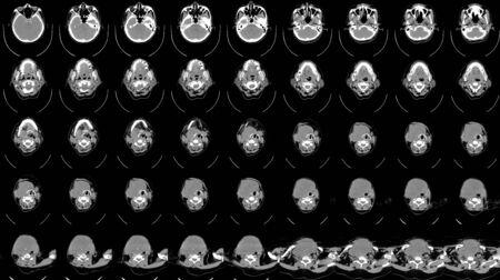 CT SCAN OF THE NECK HISTORY: A69-year-old female presented with neck mass and right TVC paralysis.The mass pressures effect to adjacent structures as describe above. Probably malignancy, tissue diagnosis is suggested.の素材 [FY310133049428]