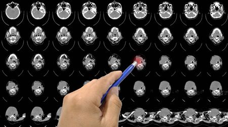 Close up hand Doctor point CT SCAN OF THE NECK HISTORY: A69-year-old female presented with neck mass and right TVC paralysis.の写真素材