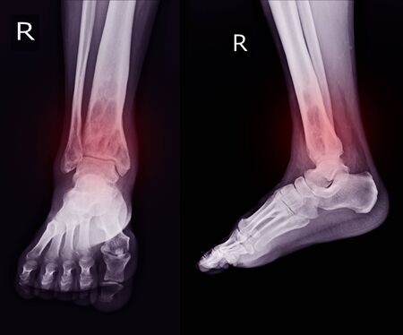 X-ray Rt.Ankle finding intramedullary osterolytic lesion of right distal tibia.  No periosteal...
