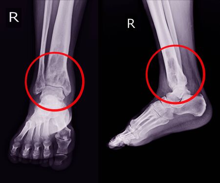 X-ray Rt.Ankle finding intramedullary osterolytic lesion of right distal tibia.  No periosteal...
