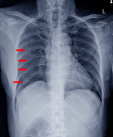 Medical image,Multiple fracture ribs x-ray chest.の写真素材