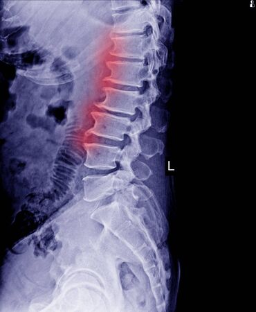 Lumbar spine x-ray show spur of vertebral body and mild scoliosis of bone.Medical image.の写真素材