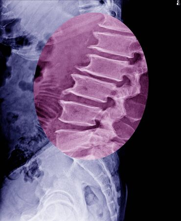 Lumbar spine x-ray show spur of vertebral body and mild scoliosis of bone.Medical image.の写真素材