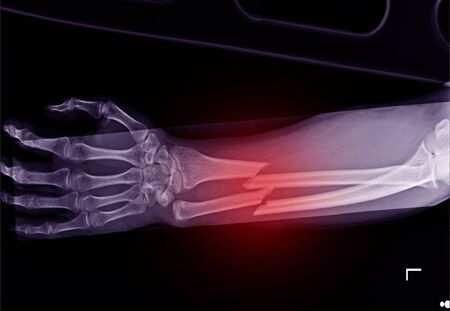 x-ray left forarm both fracture shaft of radius and  ulnar bone on red mark.の写真素材