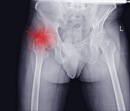 X-ray both hip (AP)f inding fracture rigth neck femur on rec arrow point.の写真素材