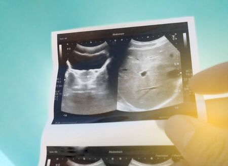 Woman holding ultrasound abdomen photo  with ligting color background.too soft and blurry image when...