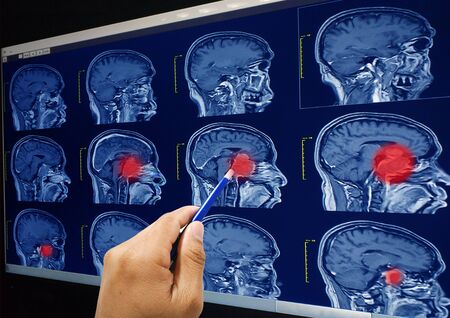 Magnetic resonance imaging (MRI) of the brain, brain tumor, brain abscess on red point , sagittal view.Healthcare and medical concept.の写真素材