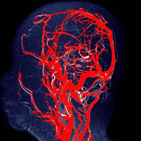 MRA brain Coronal 3D Sagittal MIP view showing Common carotid artery and cerebral artery .