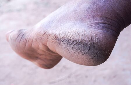 Close up foot cracked heels and dry skin In Asian women.        