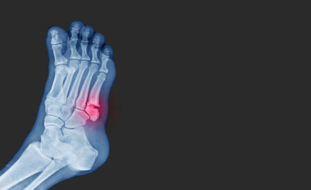 X-ray foot showing  toe 5th bone fracture ( base of metatarsal fracture ) from against the wall. Highlight on fracture site and painful.Medical healthcare concept.の写真素材