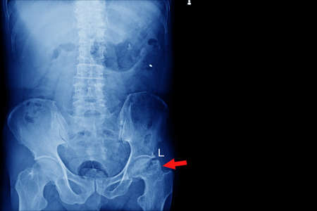X-ray lumbo-sacral spine and pelvis No fracture, dislocation , bony destruction Normal  joint space ...