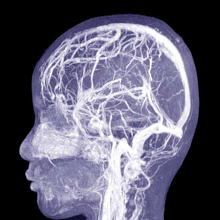 MRI THE BRAIN.Moderate perilesional vasogenic edema with 0.7 cm midline shift to the left side.Medical image concept.の素材 [FY310163859018]