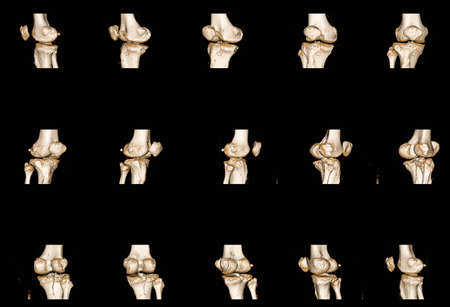 collection of x-ray human's knee joints finding fracture proximal metaphysis of tibia.Healthcare and...
