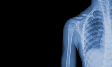x-ray images of the shoulder joint to see injuries clavicle fracture and tendons for a medical diagnosis.Medical image concept and copy space.の写真素材