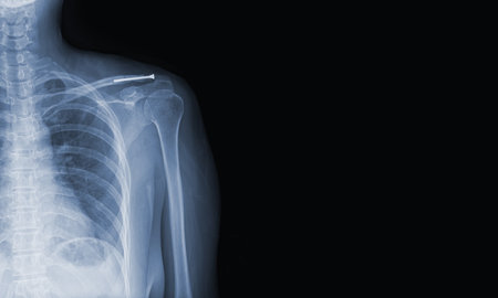 x-ray images of the shoulder joint modified coracoclavicular stabilizer to see injuries bones and tendons for a medical diagnosis.Medical image concept and copy space.の写真素材
