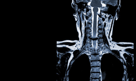 MRI (1.5 tesla) of the cervical spine was performed by axial T2W Moderate spinal cord compression at C5-6 (6 mm in AP) with myelopathy .の写真素材