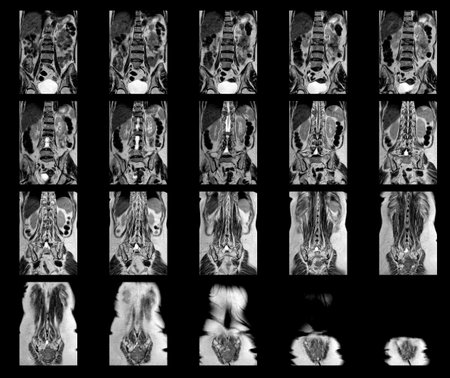 MRI OF THE THORACOLUMBAR SPINE a patient who has moderate to severe compression fractures of T11 and...
