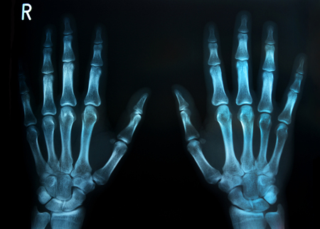 X-Ray Image of human body both hands bonesの写真素材