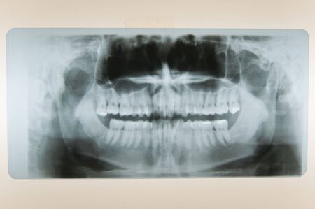 Close-up shot of dental x-ray of human teethの写真素材