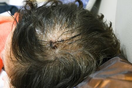 After surgery sebaceous cyst on head. Doctor suture skin women black hairの写真素材