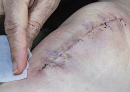 Two finger holds an alcohol pad to clean the wound stitched with dissolvable sutures after knee replacement surgery of an elderly Asian woman. The knee treated by a skilled doctor requires physical therapyの写真素材