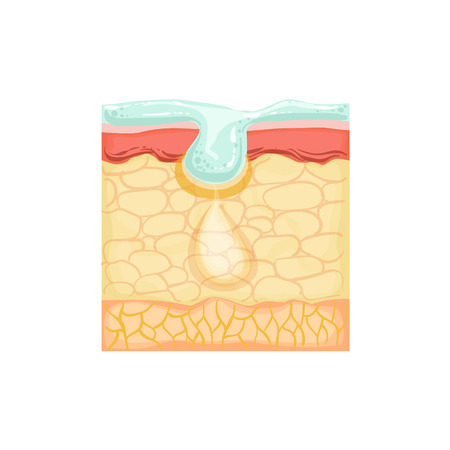 Dermatology Skincare Anatomical Info Illustration Demonstrating Skin Problem Treatment With Cosmetology Cleansing Product. Skin Concerns And Their Cosmetologically Solutions Illustration From Bad Skin Collection.のイラスト素材