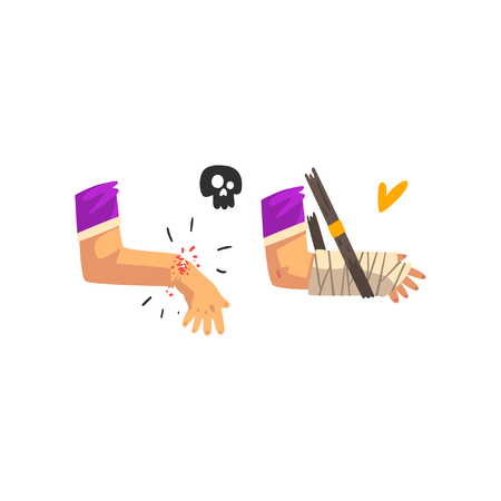 Fracture of the wrist, hand plastered, physical injury, first aid and treatment vector Illustration on a white backgroundのイラスト素材