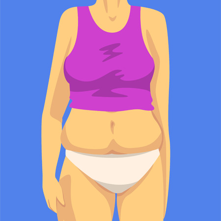 Part of Female Body with Fat Belly, Human Figure After Weight Loss, Front View, Obesity and Unhealthy Eating Problems Vector Illustrationのイラスト素材