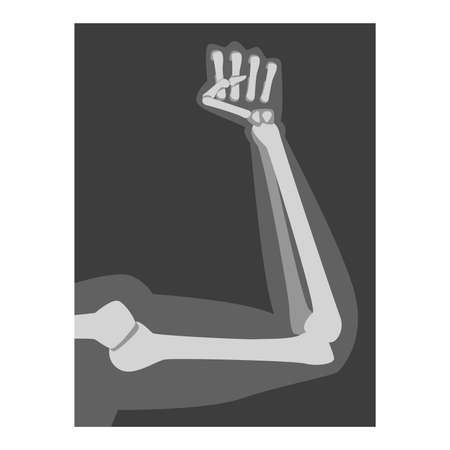 Roentgenograph of Forearm Front View Vector Imageのイラスト素材