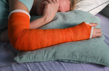 woman with a broken right arm with an orange fiberglass plaster cast sleeps in bed with a pillow under the cast, everyday life with trauma, High quality photoの写真素材