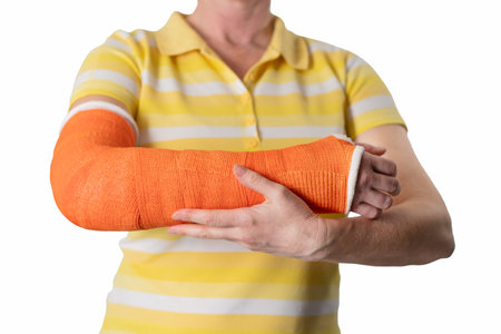 woman with a broken arm and an orange plaster plastic bandage on a white background,modern materials for the treatment of injuries,the latest medicine,on a white backgroundの写真素材