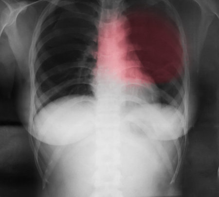X-ray Image Of Human Chestの写真素材