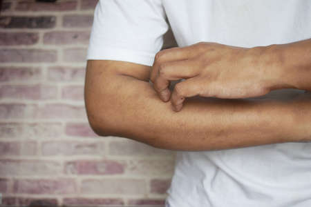 man suffering from itching skin, close up.の写真素材