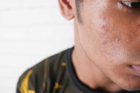 close up of young man face with skin problem .の写真素材