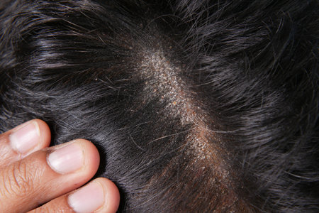 men with dandruff in his hair, closeup