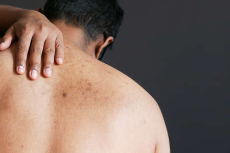 close up of young man suffering skin problem .の写真素材