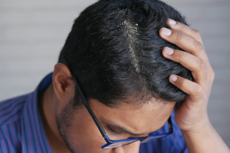 men with dandruff in his hair, closeupの写真素材