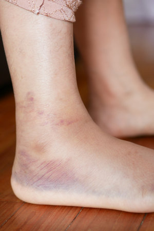 close up of women feet with swellingの写真素材