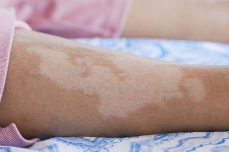 feet with vitiligo skin condition.の写真素材
