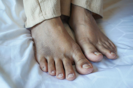 close up of women feet with swelling