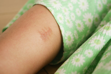 Stitched wound mark on a child foot.の写真素材