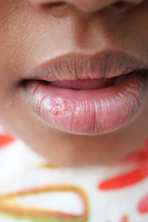 close up of dry lip of a childの写真素材