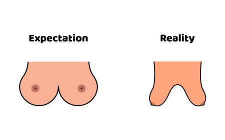 Expectation and reality of women boobs. Beautiful and ugly breast. Vectorのイラスト素材
