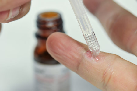 treatment wart on finger by salicylic acid.