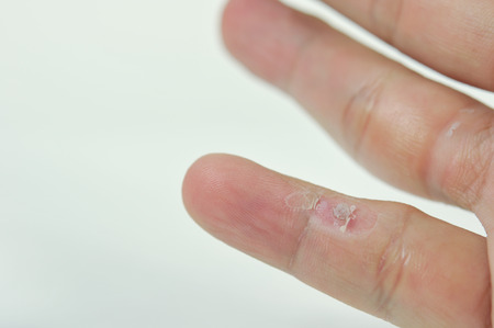 treatment wart on finger by salicylic acid.の写真素材
