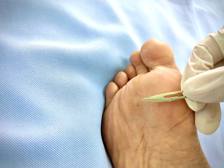 Doctor Checking, Treat and heal wart under foot, treatment by salicylic acid.