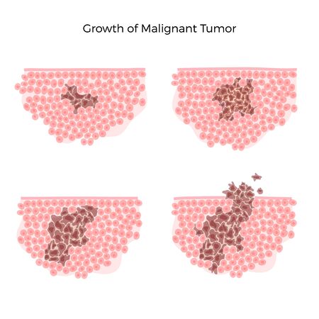 Vector isolated illustration of malignant tumor in healthy tissue. Spreading of cancer cells, tumor development. Medical infographic for poster, educational, science and medical use.のイラスト素材